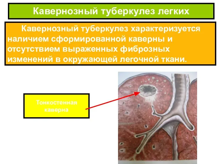 Кавернозный туберкулез характеризуется наличием сформированной каверны и отсутствием выраженных фиброзных изменений