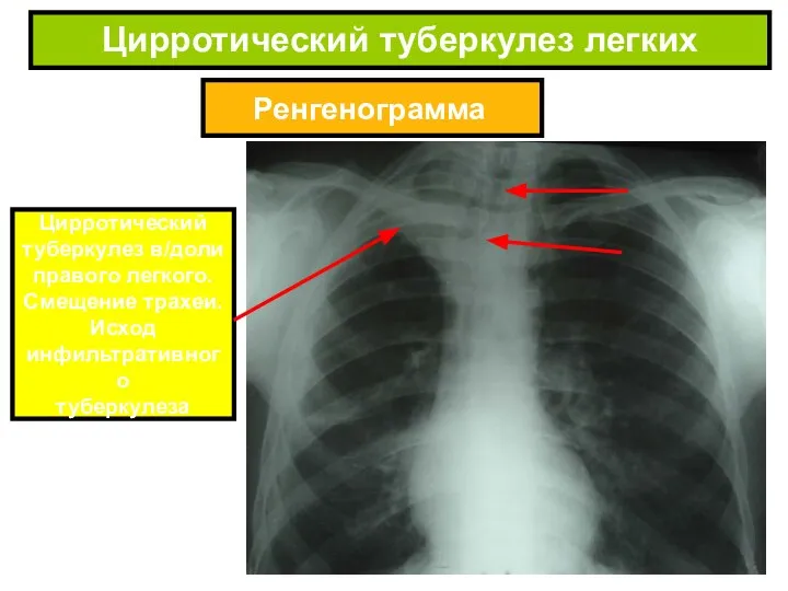 Ренгенограмма Цирротический туберкулез легких Цирротический туберкулез в/доли правого легкого. Смещение трахеи. Исход инфильтративного туберкулеза