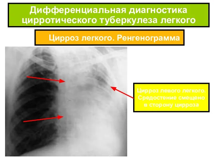Цирроз легкого. Ренгенограмма Дифференциальная диагностика цирротического туберкулеза легкого Цирроз левого легкого. Средостение смещено в сторону цирроза
