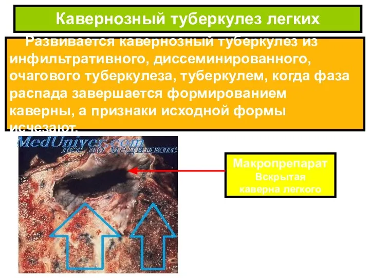 Развивается кавернозный туберкулез из инфильтративного, диссеминированного, очагового туберкулеза, туберкулем, когда фаза