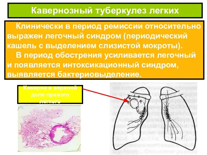 Клинически в период ремиссии относительно выражен легочный синдром (периодический кашель с