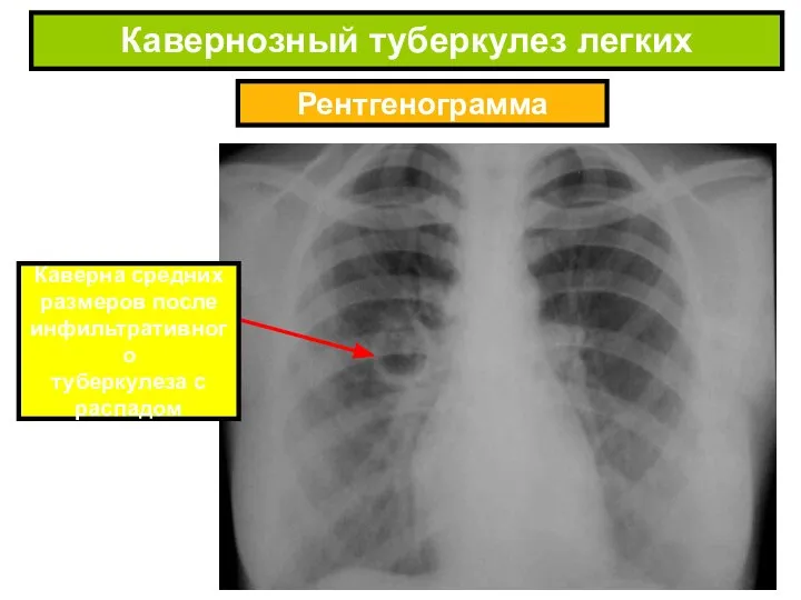 Рентгенограмма Кавернозный туберкулез легких Каверна средних размеров после инфильтративного туберкулеза c распадом