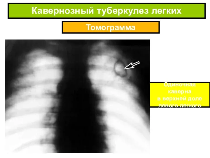 Томограмма Кавернозный туберкулез легких Одиночная каверна в верхней доле левого легкого