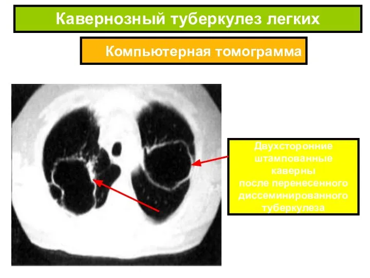 Компьютерная томограмма Кавернозный туберкулез легких Двухсторонние штампованные каверны после перенесенного диссеминированного туберкулеза