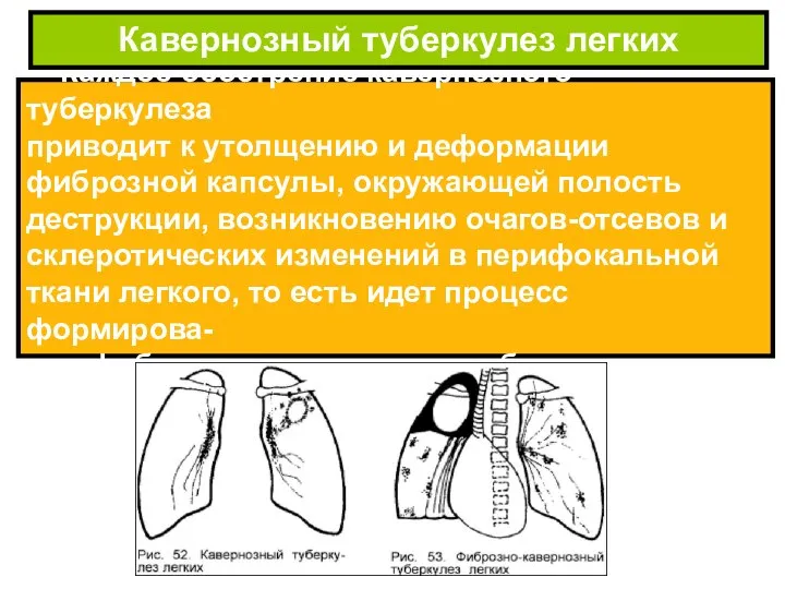 Каждое обострение кавернозного туберкулеза приводит к утолщению и деформации фиброзной капсулы,