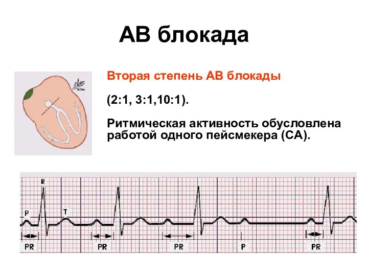 AВ блокада Вторая степень AВ блокады (2:1, 3:1,10:1). Ритмическая активность обусловлена работой одного пейсмекера (СA).