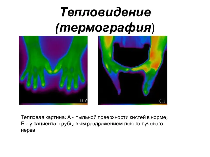 Тепловидение (термография) Тепловая картина: А - тыльной поверхности кистей в норме;