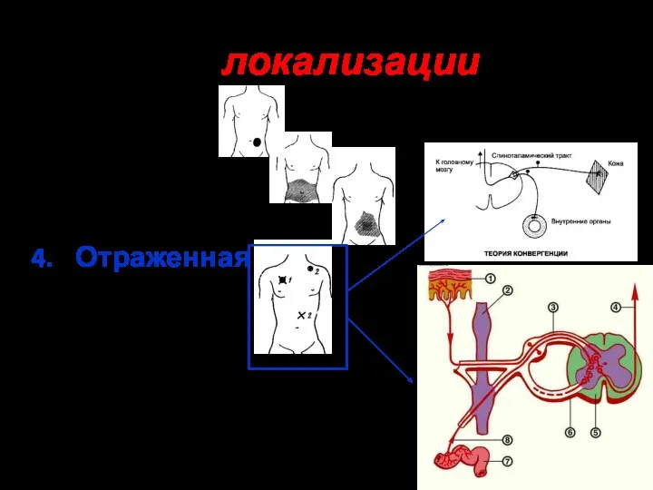 По локализации: Локальная, Диффузная, Иррадиирующая, Отраженная, Фантомная.