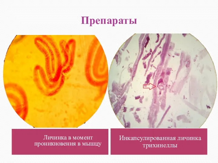 Препараты Личинка в момент проникновения в мышцу Инкапсулированная личинка трихинеллы