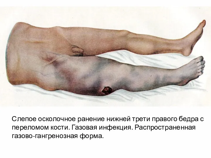 Слепое осколочное ранение нижней трети правого бедра с переломом кости. Газовая инфекция. Распространенная газово-гангренозная форма.