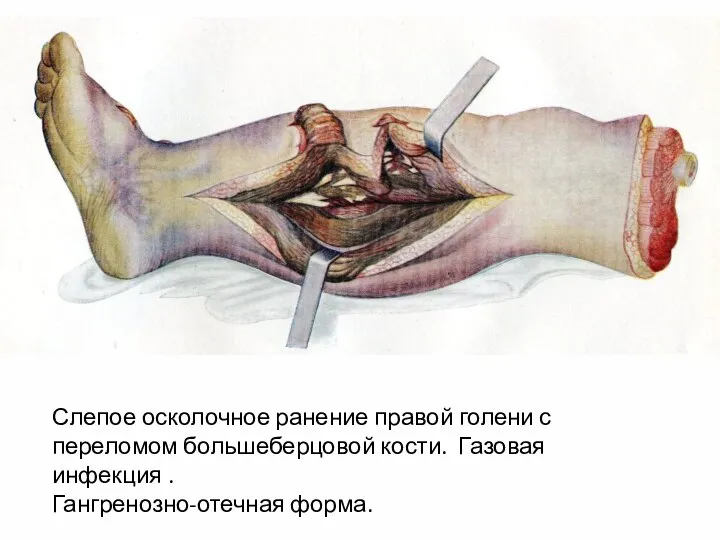 Слепое осколочное ранение правой голени с переломом большеберцовой кости. Газовая инфекция . Гангренозно-отечная форма.