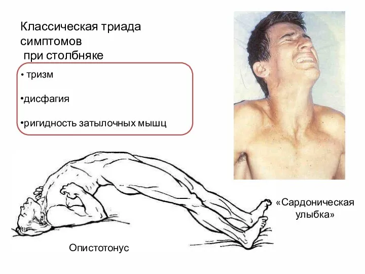 «Сардоническая улыбка» Опистотонус тризм дисфагия ригидность затылочных мышц Классическая триада симптомов при столбняке