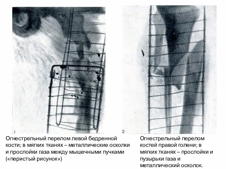 Огнестрельный перелом левой бедренной кости; в мягких тканях – металлические осколки