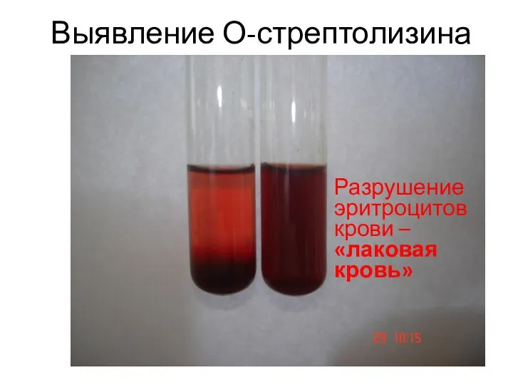 Выявление О-стрептолизина Разрушение эритроцитов крови – «лаковая кровь»