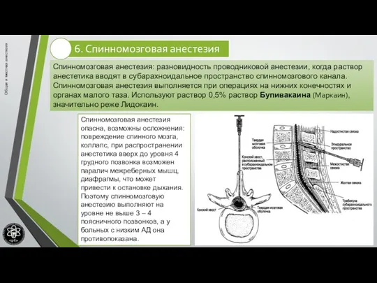 Общая и местная анестезия Спинномозговая анестезия: разновидность проводниковой анестезии, когда раствор