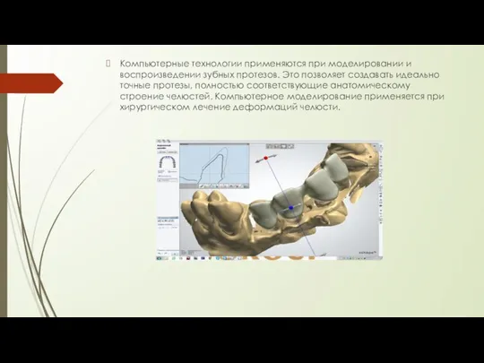 Компьютерные технологии применяются при моделировании и воспроизведении зубных протезов. Это позволяет