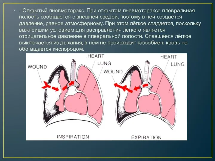 - Открытый пневмоторакс. При открытом пневмотораксе плевральная полость сообщается с внешней