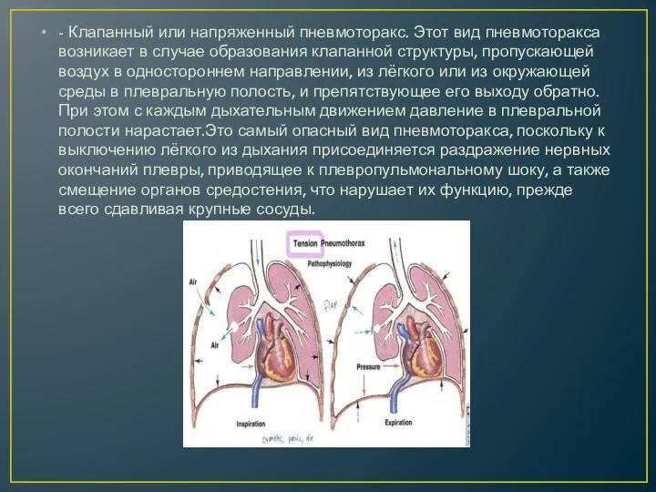 - Клапанный или напряженный пневмоторакс. Этот вид пневмоторакса возникает в случае