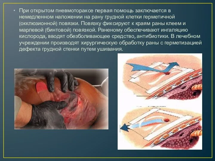 При открытом пневмотораксе первая помощь заключается в немедленном наложении на рану