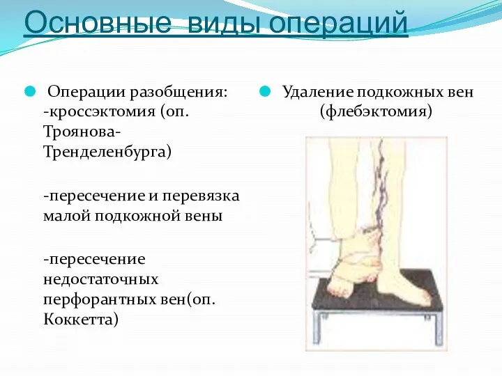 Основные виды операций Операции разобщения: -кроссэктомия (оп.Троянова- Тренделенбурга) -пересечение и перевязка