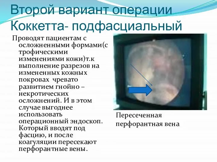 Второй вариант операции Коккетта- подфасциальный Проводят пациентам с осложненными формами(с трофическими