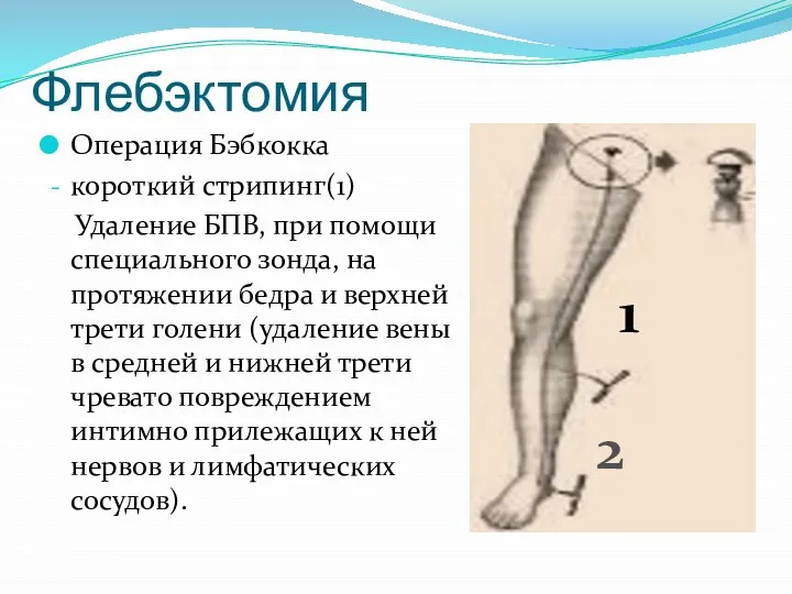 Флебэктомия Операция Бэбкокка короткий стрипинг(1) Удаление БПВ, при помощи специального зонда,