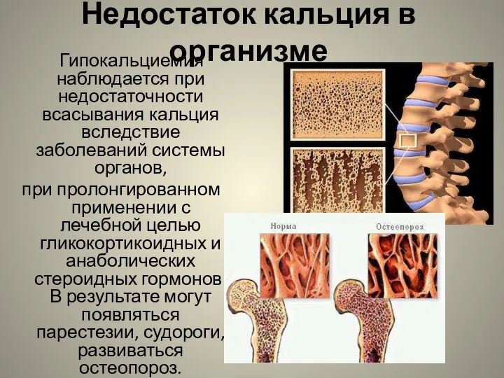 Недостаток кальция в организме Гипокальциемия наблюдается при недостаточности всасывания кальция вследствие