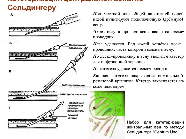 Катетеризация центральной вены по Сельдингеру Под местной или общей анестезией полой