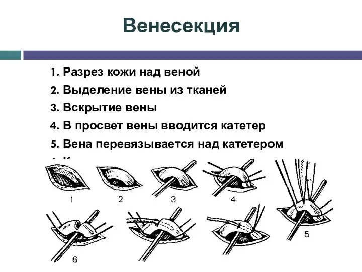 Венесекция 1. Разрез кожи над веной 2. Выделение вены из тканей