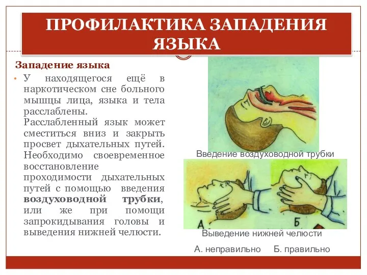 ПРОФИЛАКТИКА ЗАПАДЕНИЯ ЯЗЫКА Западение языка У находящегося ещё в наркотическом сне