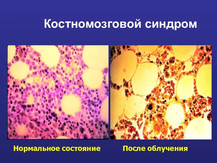 Костномозговой синдром Нормальное состояние После облучения