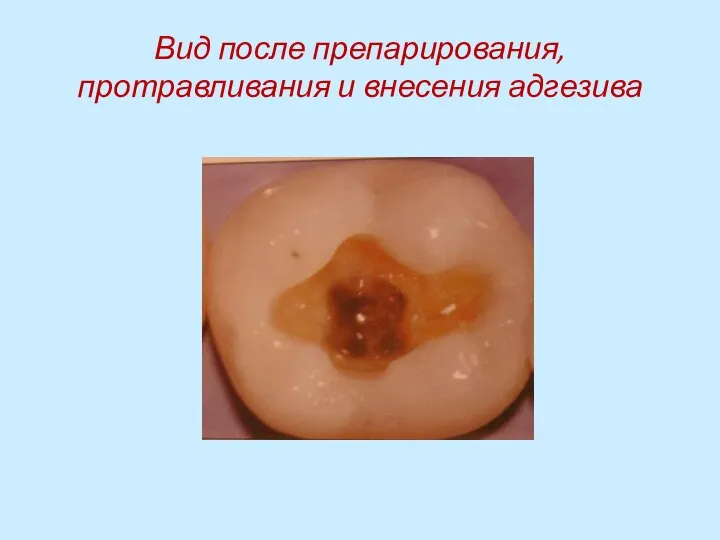 Вид после препарирования, протравливания и внесения адгезива