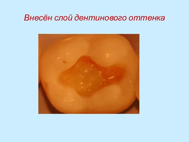 Внесён слой дентинового оттенка