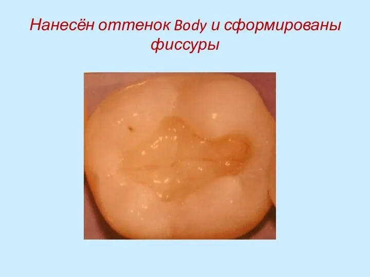 Нанесён оттенок Body и сформированы фиссуры