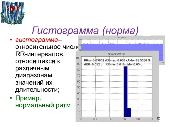 Гистограмма (норма) гистограмма– относительное число RR-интервалов, относящихся к различным диапазонам значений их длительности; Пример: нормальный ритм