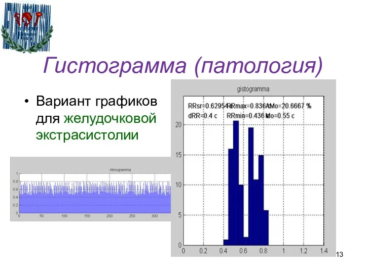 Гистограмма (патология) Вариант графиков для желудочковой экстрасистолии