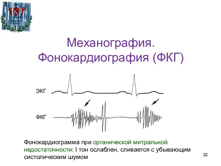 Механография. Фонокардиография (ФКГ) Фонокардиограмма при органической митральной недостаточности: I тон ослаблен,