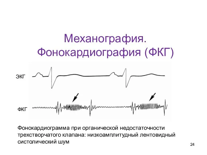 Механография. Фонокардиография (ФКГ) Фонокардиограмма при органической недостаточности трехстворчатого клапана: низкоамплитудный лентовидный систолический шум ЭКГ ФКГ