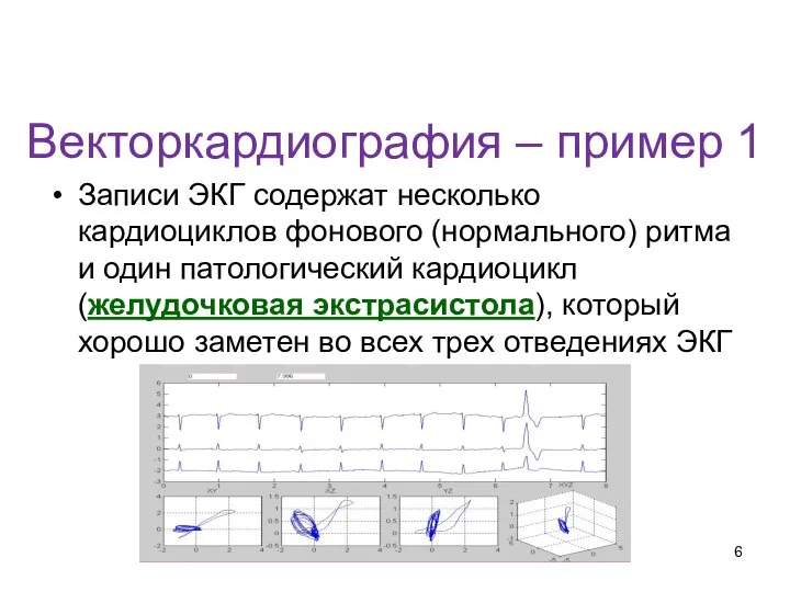 Векторкардиография – пример 1 Записи ЭКГ содержат несколько кардиоциклов фонового (нормального)