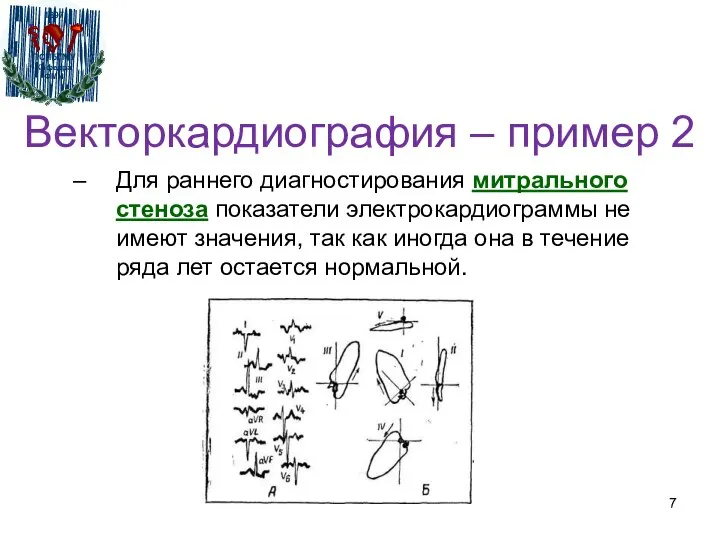 Векторкардиография – пример 2 Для раннего диагностирования митрального стеноза показатели электрокардиограммы