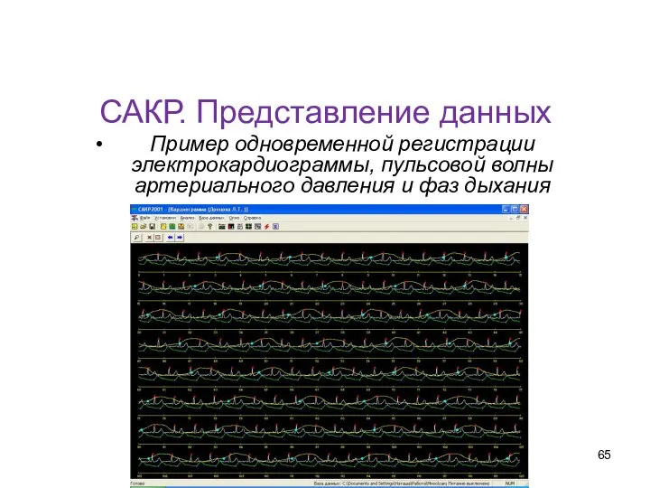 САКР. Представление данных Пример одновременной регистрации электрокардиограммы, пульсовой волны артериального давления и фаз дыхания