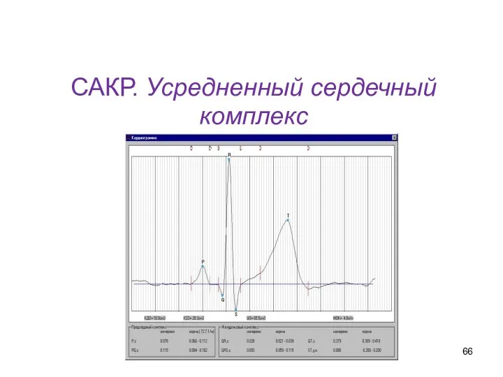 САКР. Усредненный сердечный комплекс