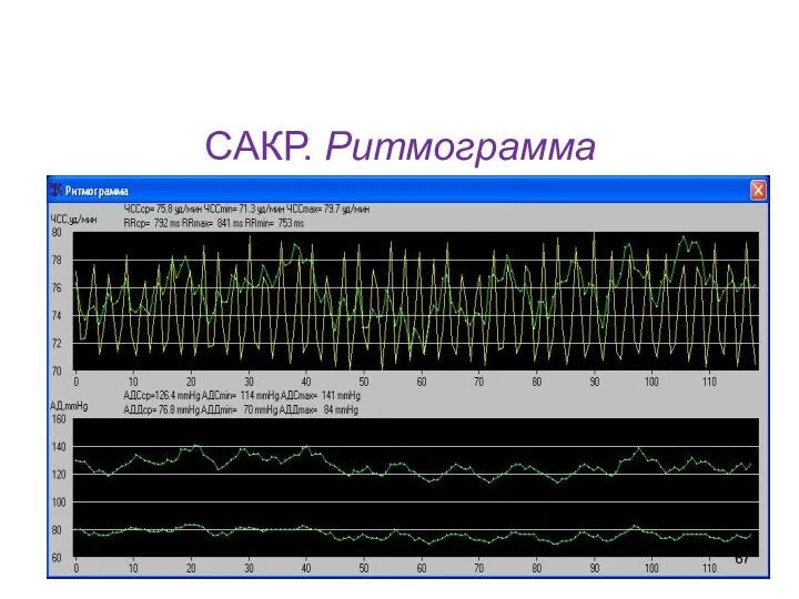 САКР. Ритмограмма