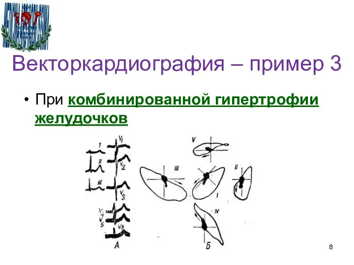 Векторкардиография – пример 3 При комбинированной гипертрофии желудочков