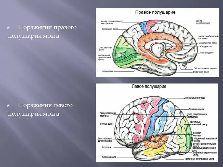 Поражения правого полушария мозга Поражения левого полушария мозга