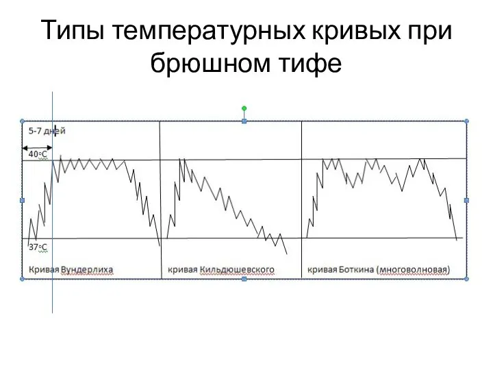 Типы температурных кривых при брюшном тифе