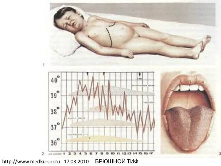 http://www.medkursor.ru 17.03.2010 БРЮШНОЙ ТИФ