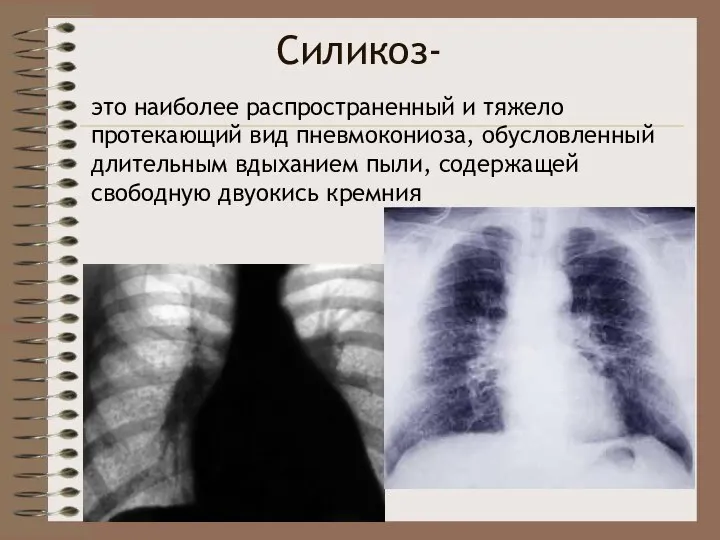 Силикоз- это наиболее распространенный и тяжело протекающий вид пневмокониоза, обусловленный длительным