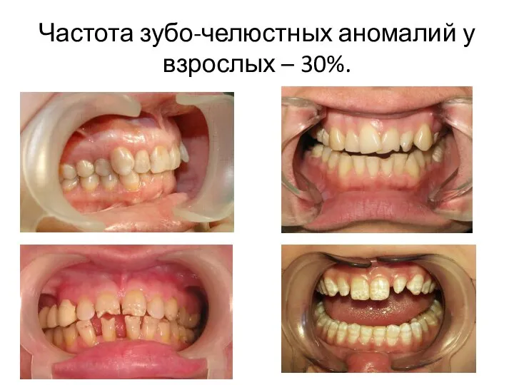 Частота зубо-челюстных аномалий у взрослых – 30%.