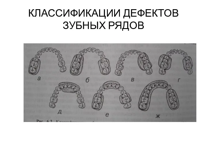 КЛАССИФИКАЦИИ ДЕФЕКТОВ ЗУБНЫХ РЯДОВ